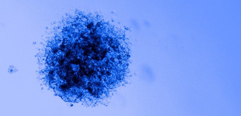 image of blue breast cancer cells
that formed a tumorsphere in vitro
by Kassondra Meyer